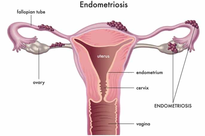 Gejala endometriosis