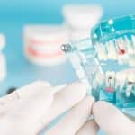 Biaya Perawatan Saluran Akar Gigi di Rumah Sakit dan Klinik
